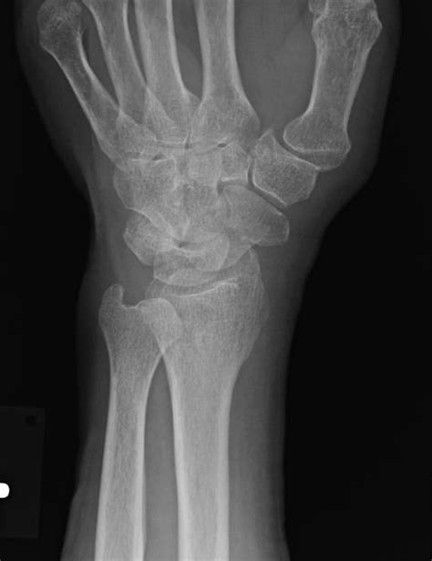 Scaphoid And Triquetrum Fracture Radiology Case