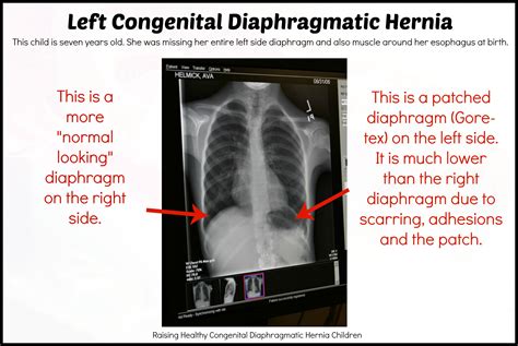 Pin On Raising Healthy Congenital Diaphragmatic Hernia Children
