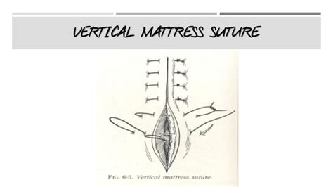 Study suture patterns flashcards from matt steele's class online, or in brainscape's iphone or android app. Suturing Techniques