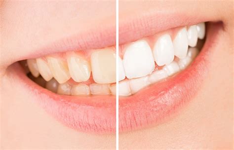The Causes Of Tooth Discoloration