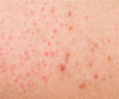 What Is Folliculitis Prevention And Treatment