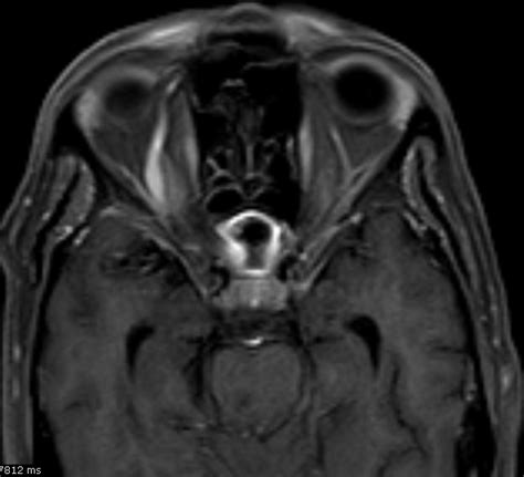 Early Cavernous Sinus Thrombosis Gd Mri Sumers Radiology Blog