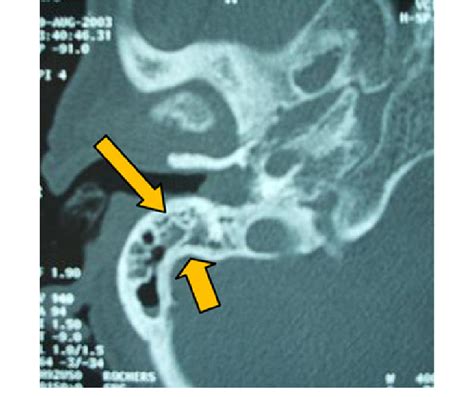 Ct Scan Showing Extensive Destruction Of The Right Petrous Bone