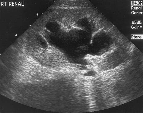 Complications Of Ureteral Stent Placement Radiographics