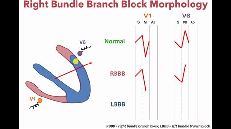 Left Bundle Branch Anatomy