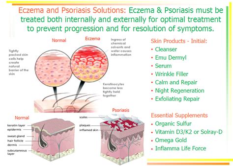 Eczema And Psoriasis—understanding The Cause Can Help You Find A Solution
