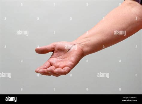 Arm With Stitches From Carpal Tunnel Surgery Stock Photo Alamy