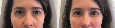 Juvéderm® And Restylane® Before And After Pictures Case 25 Charlotte