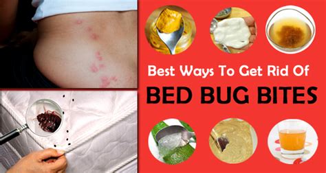 How To Get Rid Of Bed Bug Bites And Itchiness Fast