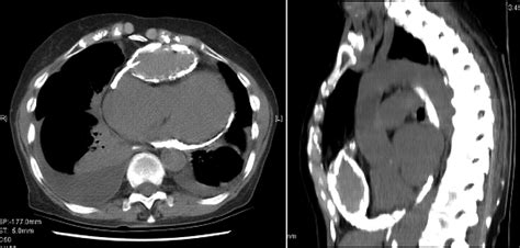 Cystic Tuberculous Constrictive Pericarditis Cmaj