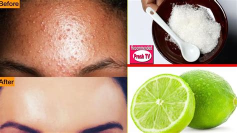 how to remove pimples overnight । acne treatment । remove pimples overnight with lemon clear
