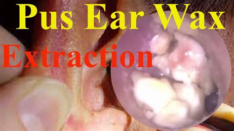 Hard Ear Wax Extraction Let See The Doctor Moved Ep4 Youtube