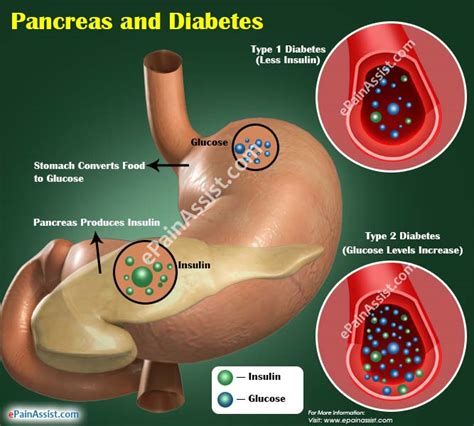 Does The Pancreas Have Anything To Do With Diabetes Diabeteswalls