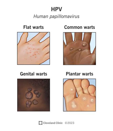 Top 7 Symptoms Of Hpv In Men 2022