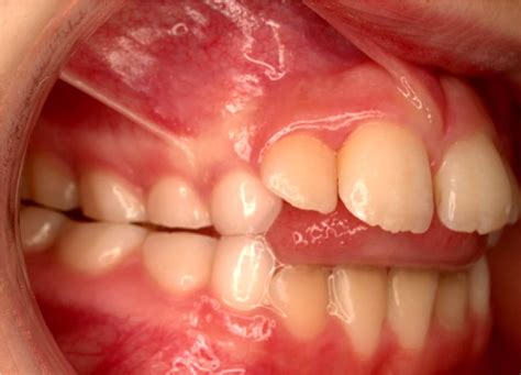 What Is Tongue Thrust And Why Is It A Problem News Dentagama