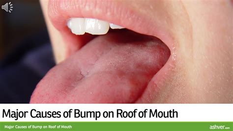 Major Causes Of Bump On Roof Of Mouth Youtube