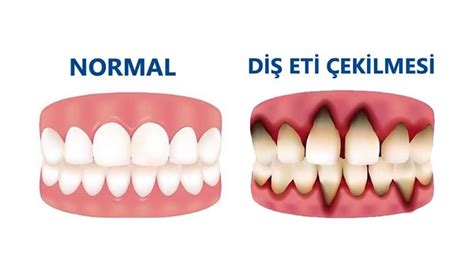 Diş Eti Çekilmesi Nedir Nasıl Tedavi Edilir Dental Estetik Center