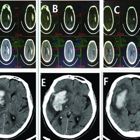 A Ct Scans Of One Patient On Admission B Ct Scans Of The Same