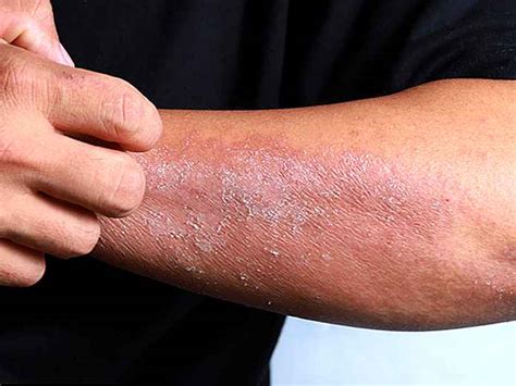 Dermatitis De Contacto Tipos Causas Y Síntomas Esodysseedubienetrebe