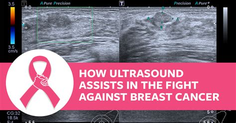 Breast Ultrasound And How It Is Used To Fight Against Breast Cancer Wcui