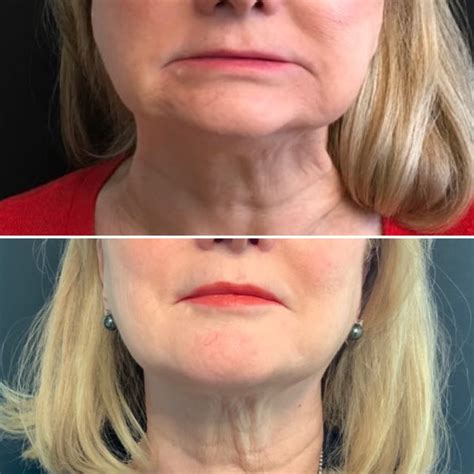 Kybella For Jowls And Submental Fat Dallas Derm Partners