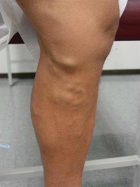 They are generally caused by pressure in the veins that. Varicose Veins Houston | Spider Veins Houston | Dr. David ...