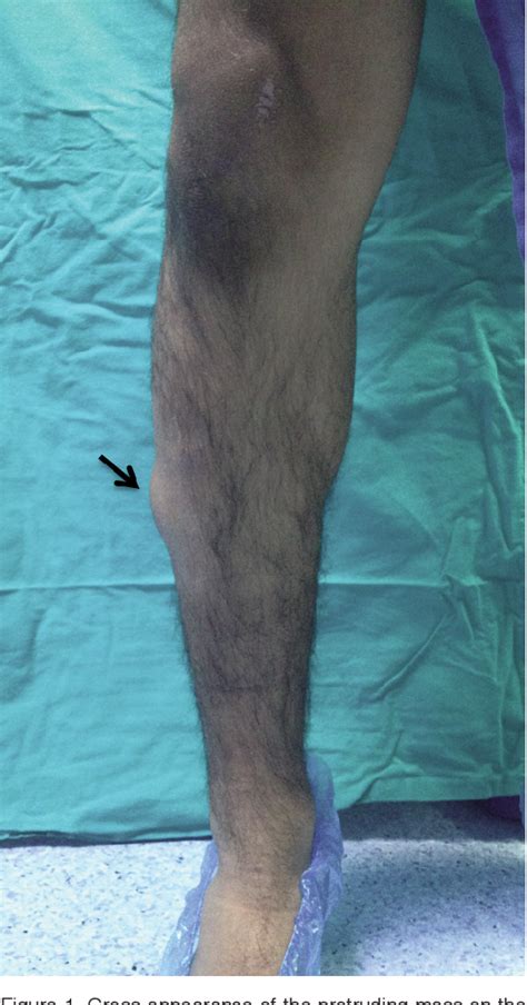 Figure 3 From Double Layer Repair Of Tibialis Anterior Muscle Hernia In