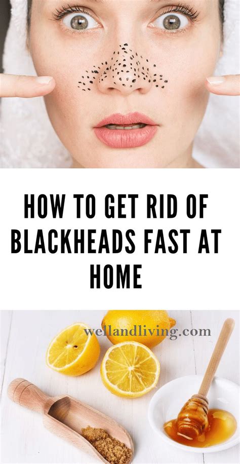 How To Get Rid Of Blackheads Moles And Warts Fast At Home Well And