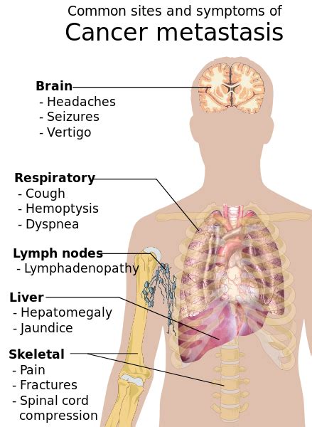 Staging is a way of describing the how extensive the breast cancer is, including the size of the tumor, whether it has spread to lymph nodes, if it has spread to distant parts of the m1: File:Symptoms of cancer metastasis.svg - Wikimedia Commons