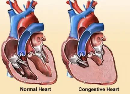 Insuficiência Cardíaca Congestiva ICC