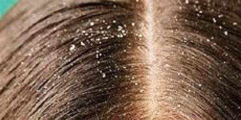Side effects Of Dandruff, Its Types, Causes, And How To Treat It
