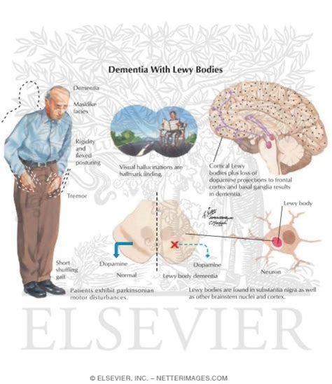 Dementia With Lewy Bodies