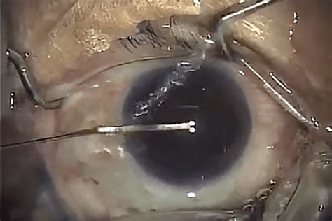 Actual Cataract Removal