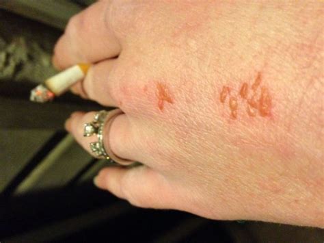 Carpet Beetle Dermatitis Images