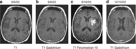 Patient With Stroke Axial T1 Weighted Mri Without A And With B
