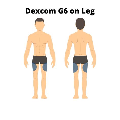 Where to Put Dexcom G6 on Leg? - PostureInfoHub