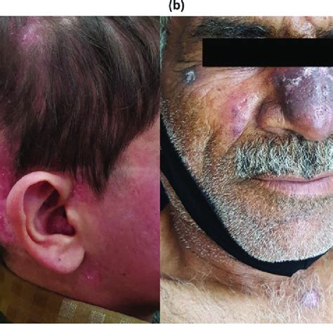Discoid Lupus Erythematosus Dle Involving The Face A And Scalp B