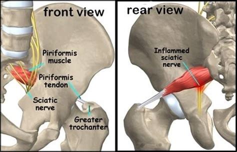 Hip fractures put the elderly at risk due to lower bone/muscle density, concomitant conditions, long recovery time, and hip surgery recovery complications. Piriformis syndrome | Joint Replacement Patient Forum