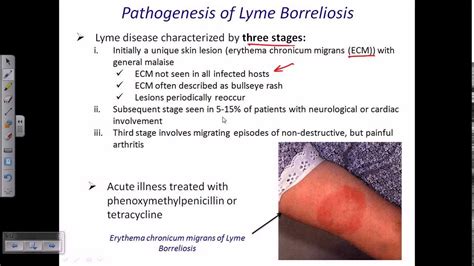 Lyme Disease By Borrelia Youtube