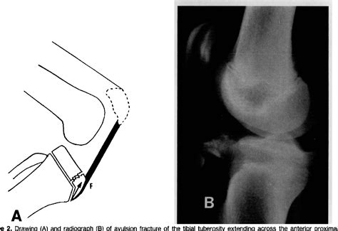 Figure 2 From Avulsion Fractures Of The Tibial Tuberosity In The