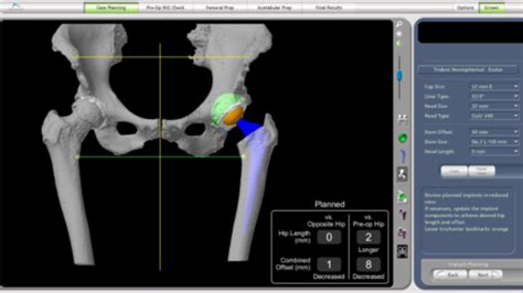 Robotic Hip Replacement Total Hip Replacement Total Knee