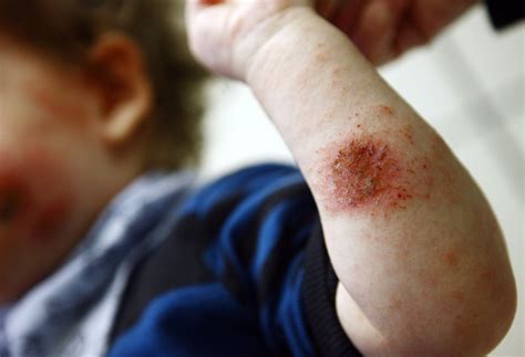 Hautausschlag Bei Kindern Tipps Sat1 Ratgeber