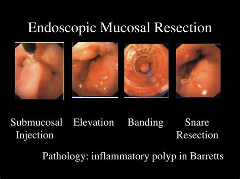Ppt Endoscopic Mucosal Resection Powerpoint Presentation Free Download Id