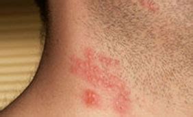 This is not the most common type of hsv but when it occurs, it usually can be seen below the waist of the body as sores. Hsv2 - File:HSV-2 Swift232.png - Wikimedia Commons / Herpes is separated into two types: - Blog ...