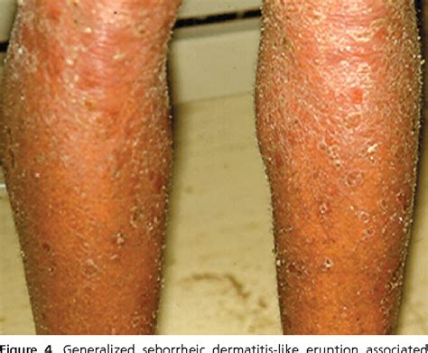 Pdf Seborrheic Dermatitis An Overview Semantic Scholar