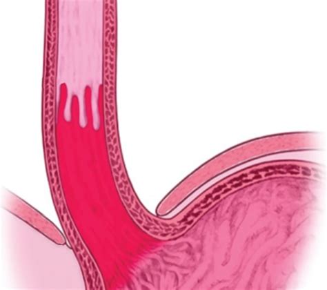 Endoscopy For Barretts Esophagus Gastroenterology And Endoscopy News
