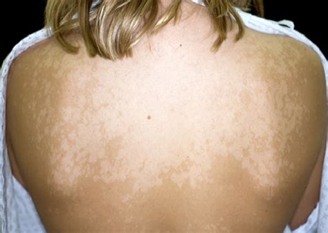 Pityriasis Versicolor Scalp Medical Information