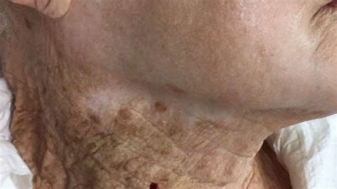 Woman Uses Spf On Her Face And Not On Neck Photo Of Her Damaged Neck