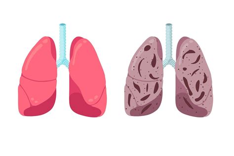 Healthy And Unhealthy Lungs Compare Concept Human Respiratory System