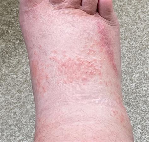 Small Itchy Bumps On Ankles